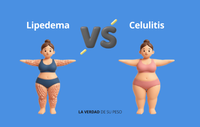 Tres figuras femeninas de perfil mostrando distintos grados de acumulación de grasa en piernas, junto al texto "¿Qué es el lipedema?", logo de Novo Nordisk