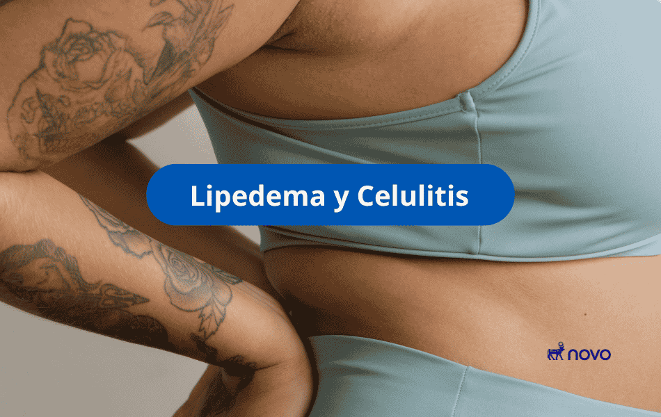 Comparación de dos figuras femeninas: una con piernas y brazos con textura nodular por lipedema, otra con textura de piel por celulitis, texto "Lipedema VS Celulitis - La verdad de su peso"