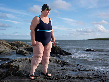¿Cómo afecta la obesidad al sistema inmunológico?
